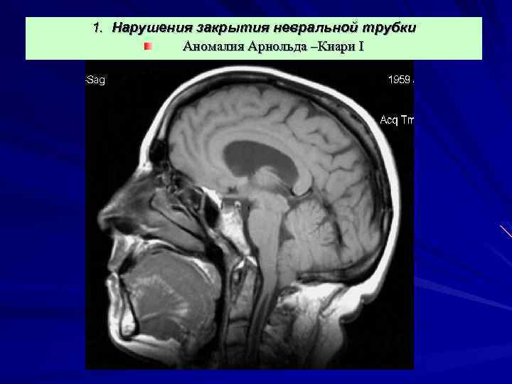 1. Нарушения закрытия невральной трубки Аномалия Арнольда –Киари I 