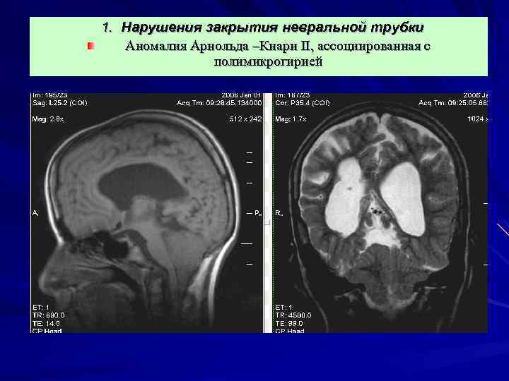1. Нарушения закрытия невральной трубки Аномалия Арнольда –Киари II, ассоциированная с полимикрогирией 
