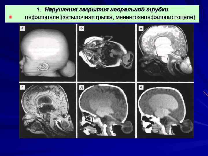 1. Нарушения закрытия невральной трубки цефалоцеле (затылочная грыжа, менингоэнцефалоцистоцеле) 