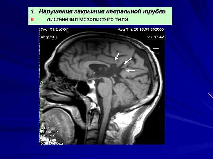 1. Нарушения закрытия невральной трубки дисгенезия мозолистого тела 