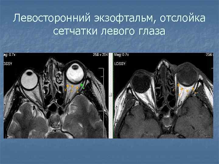 Левосторонний экзофтальм, отслойка сетчатки левого глаза 