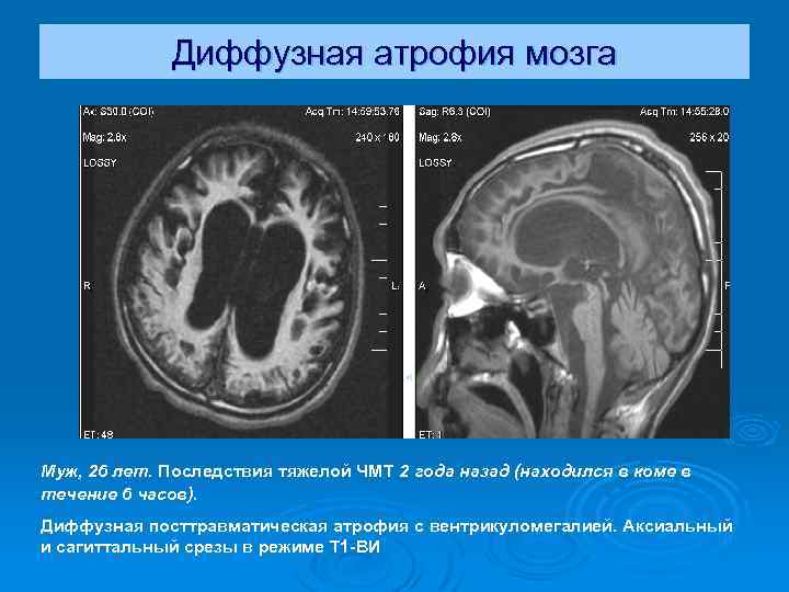 Диффузная атрофия мозга Муж, 26 лет. Последствия тяжелой ЧМТ 2 года назад (находился в