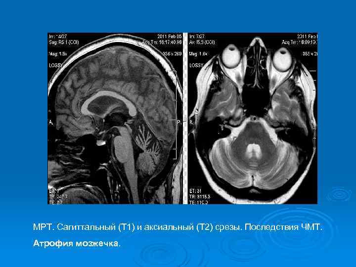МРТ. Сагиттальный (Т 1) и аксиальный (Т 2) срезы. Последствия ЧМТ. Атрофия мозжечка. 