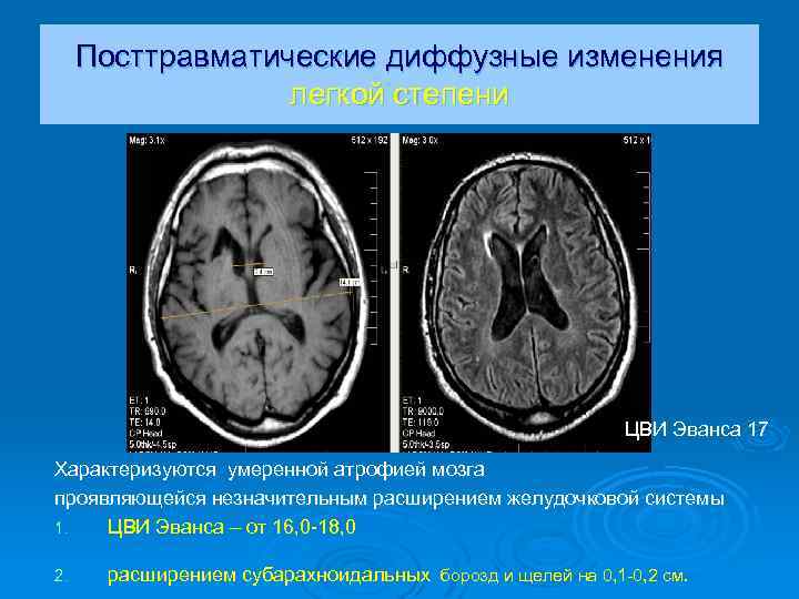 Посттравматические диффузные изменения легкой степени ЦВИ Эванса 17 Характеризуются умеренной атрофией мозга проявляющейся незначительным