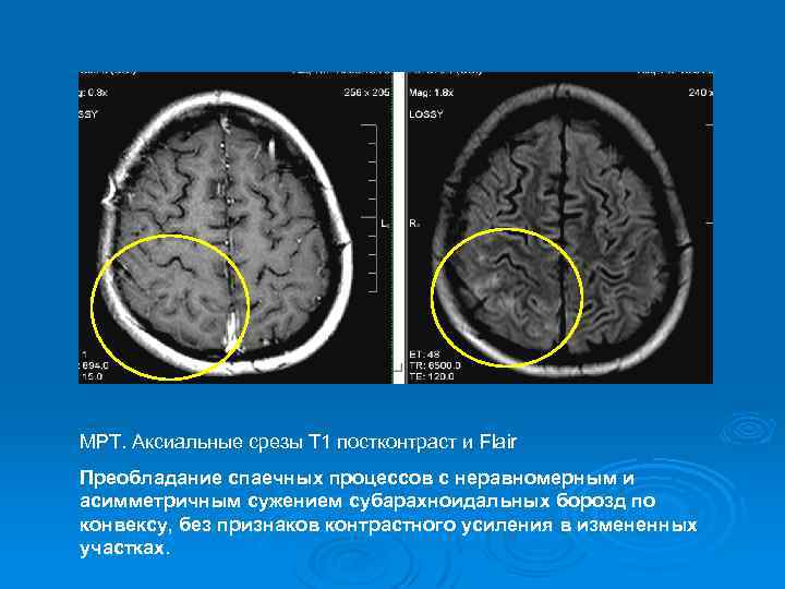 Мр картина умеренного неравномерного расширения субарахноидального конвекситального пространства