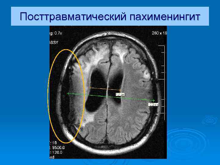 Посттравматический пахименингит 