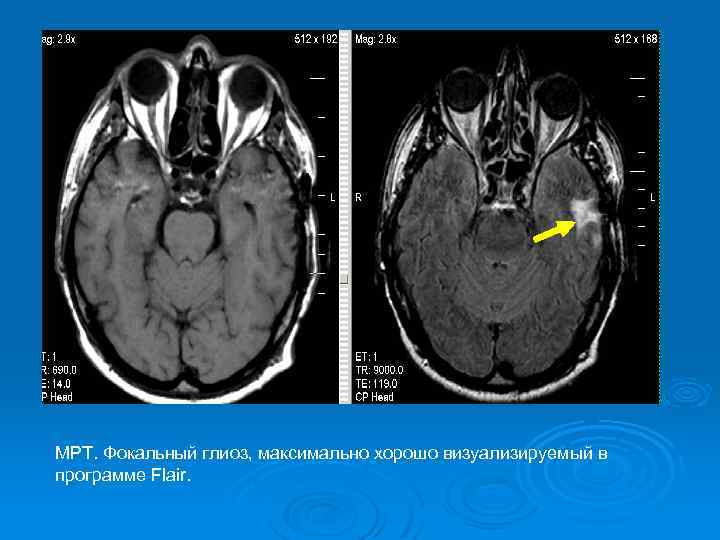 МРТ. Фокальный глиоз, максимально хорошо визуализируемый в программе Flair. 