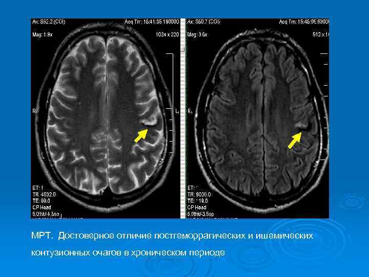 МРТ. Достоверное отличие постгеморрагических и ишемических контузионных очагов в хроническом периоде 