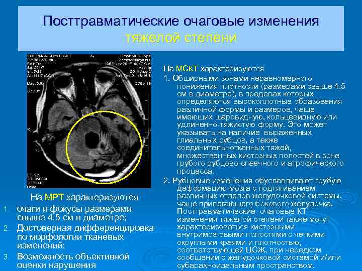 Очаговые изменения. Очаговые изменения мрт. Посттравматические изменения мрт. Что значит очаговые изменения.