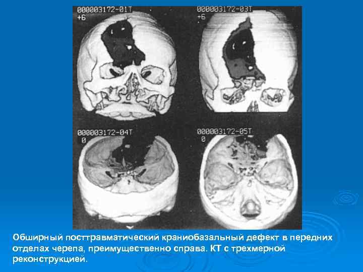 Обширный посттравматический краниобазальный дефект в передних отделах черепа, преимущественно справа. КТ с трехмерной реконструкцией.
