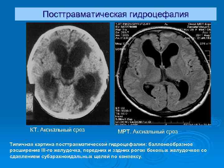 Картина заместительной гидроцефалии. Гидроцефалия расширение желудочков. Аксиальный срез мрт. Рентгенодиагностика гидроцефалии. Методы исследования гидроцефалии.