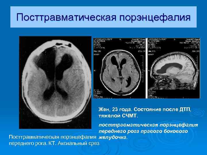 Порэнцефалическая киста