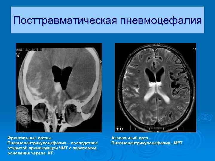 Посттравматическая пневмоцефалия Фронтальные срезы. Пневмовентрикулоцефалия – последствие открытой проникающей ЧМТ с переломом основания черепа.