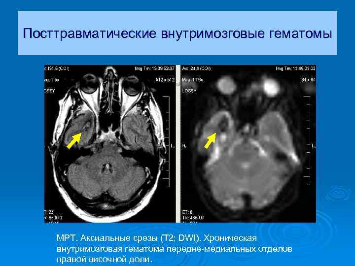 Посттравматические внутримозговые гематомы МРТ. Аксиальные срезы (Т 2; DWI). Хроническая внутримозговая гематома передне-медиальных отделов