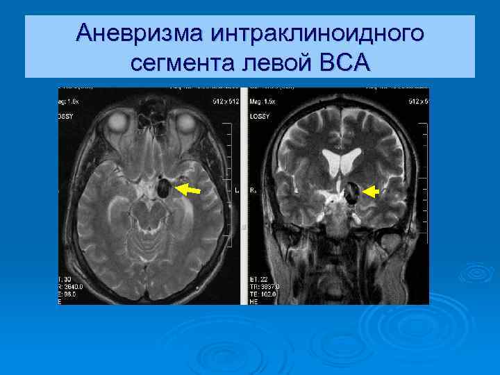 Аневризма интраклиноидного сегмента левой ВСА 