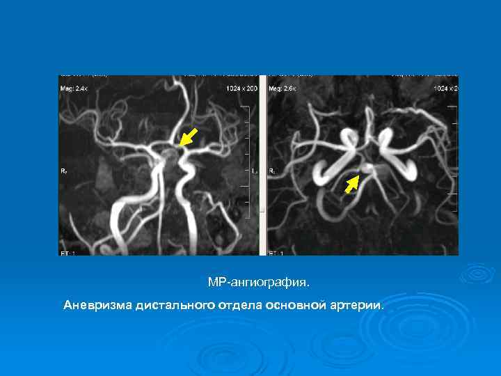 МР-ангиография. Аневризма дистального отдела основной артерии. 