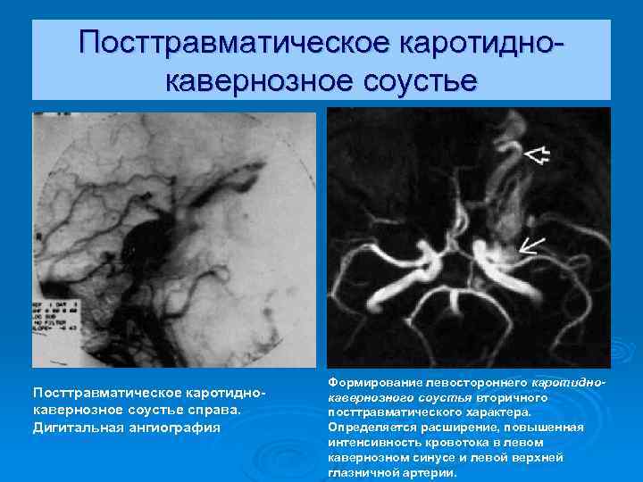 Посттравматическое каротиднокавернозное соустье справа. Дигитальная ангиография Формирование левостороннего каротиднокавернозного соустья вторичного посттравматического характера. Определяется