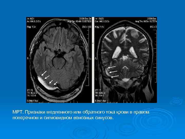 Гипоплазия левого поперечного синуса головного мозга. Тромбоз синусов головного мозга кт. Кт тромба сигмавидного синуса. Тромбоз сагиттального синуса мрт. Тромбоз синусов головного мозга мрт.