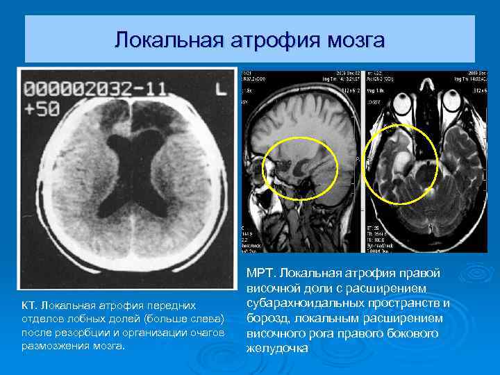 Локальная атрофия мозга КТ. Локальная атрофия передних отделов лобных долей (больше слева) после резорбции