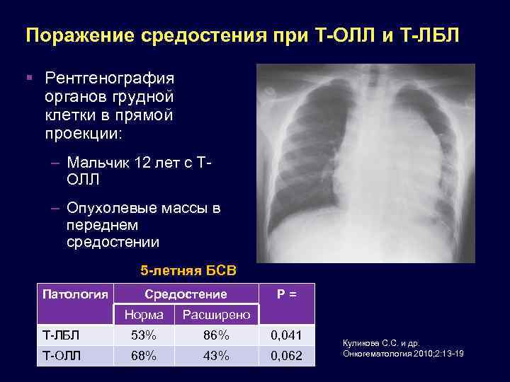 Поражение средостения при Т-ОЛЛ и Т-ЛБЛ Рентгенография органов грудной клетки в прямой проекции: –