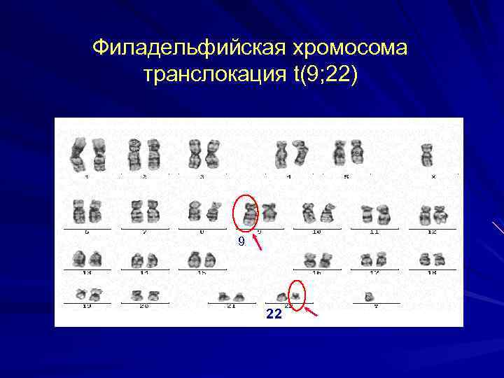 Филадельфийская хромосома транслокация t(9; 22) 9 22 