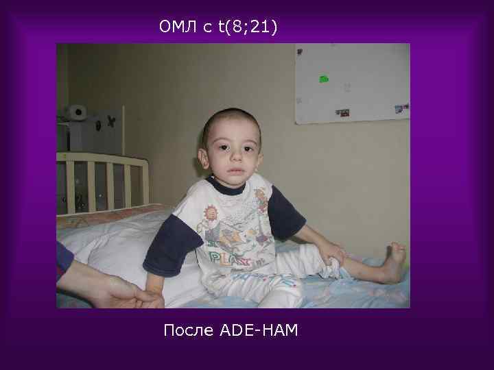 ОМЛ с t(8; 21) После ADE-HAM 