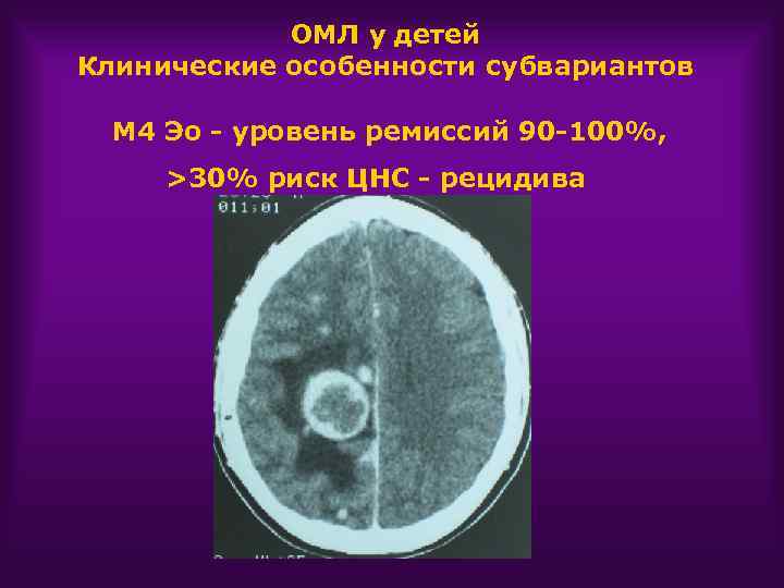 ОМЛ у детей Клинические особенности субвариантов М 4 Эо - уровень ремиссий 90 -100%,