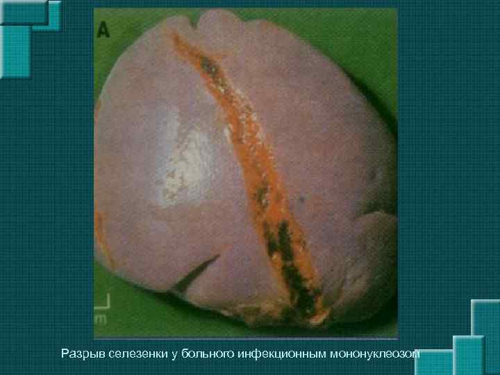  Разрыв селезенки у больного инфекционным мононуклеозом 