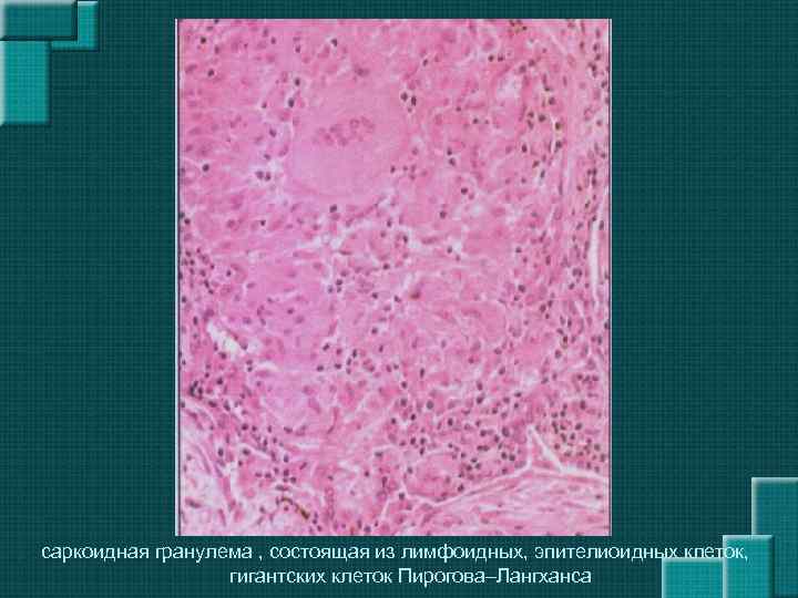 саркоидная гранулема , состоящая из лимфоидных, эпителиоидных клеток, гигантских клеток Пирогова–Лангханса 