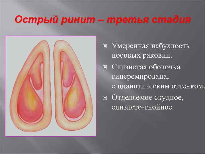 Риноскопическая картина при аллергическом рините