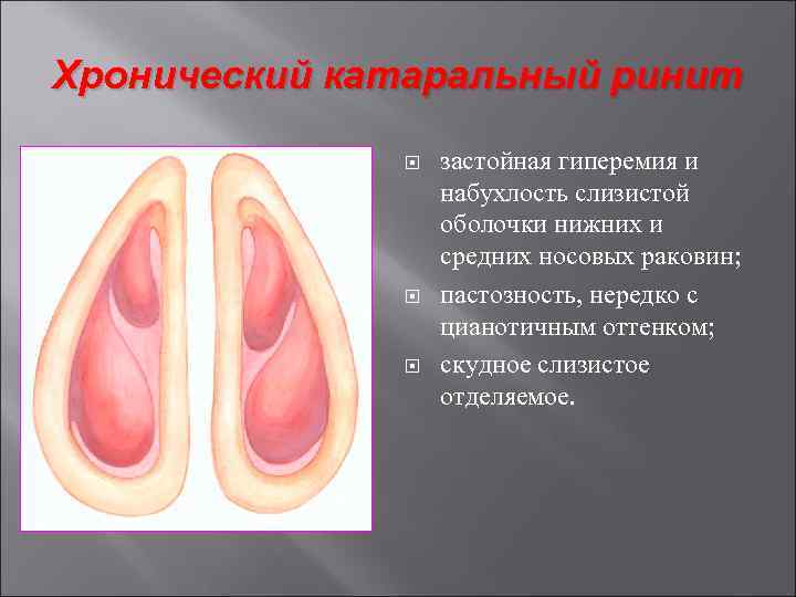 Хронический катаральный ринит застойная гиперемия и набухлость слизистой оболочки нижних и средних носовых раковин;