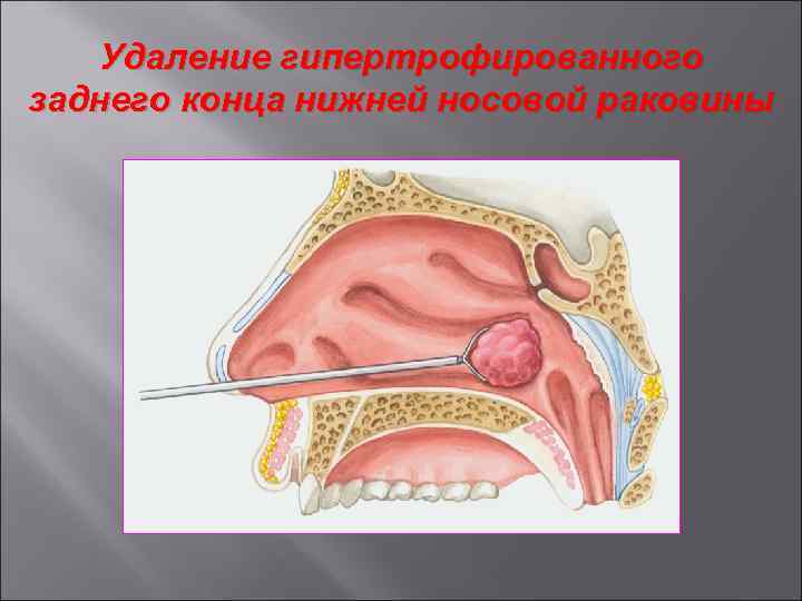 Вазотомия носа. Подслизистая вазотомия нижних. Гипертрофия нижних носовых раковин. Задние концы нижних носовых раковин.