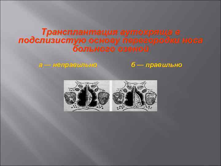 Трансплантация аутохряща в подслизистую основу перегородки носа больного озеной а — неправильно б —