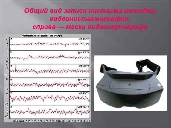 Общий вид записи нистагма методом видеонистагмографии, справа — маска видеоокулографа 