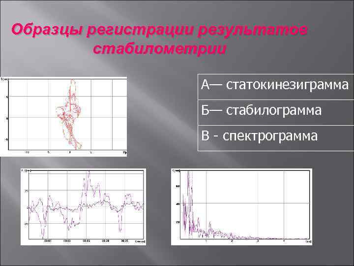 Образцы регистрации результатов стабилометрии А— статокинезиграмма Б— стабилограмма В - спектрограмма 