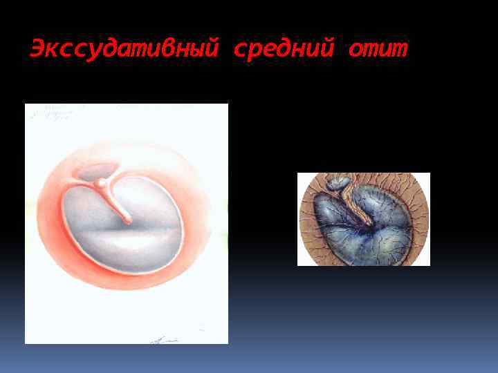 Экссудативный средний отит 