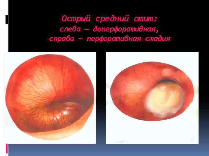 Острый средний отит: слева — доперфоративная, справа — перфоративная стадия 