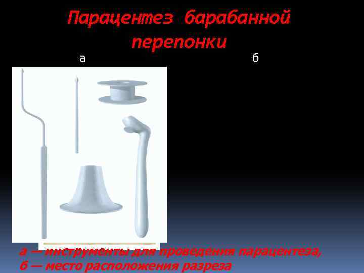 Парацентез барабанной перепонки а б а — инструменты для проведения парацентеза, б — место