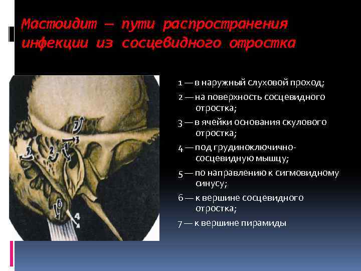 Мастоидит — пути распространения инфекции из сосцевидного отростка 1 — в наружный слуховой проход;