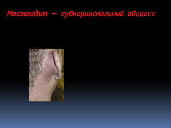 Мастоидит — субпериостальный абсцесс 