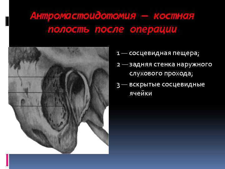 Антромастоидотомия — костная полость после операции 1 — сосцевидная пещера; 2 — задняя стенка