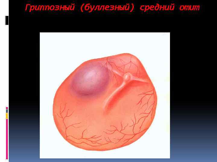 Гриппозный (буллезный) средний отит 