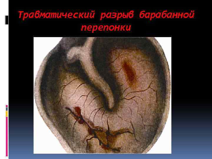 Травматический разрыв барабанной перепонки 
