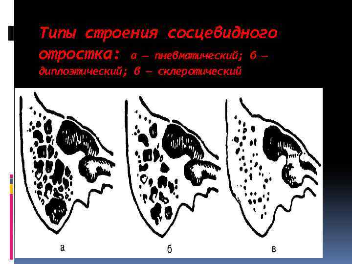 Типы строения сосцевидного отростка: а — пневматический; б — диплоэтический; в — склеротический 