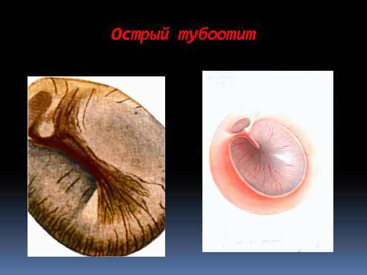 Острый тубоотит 