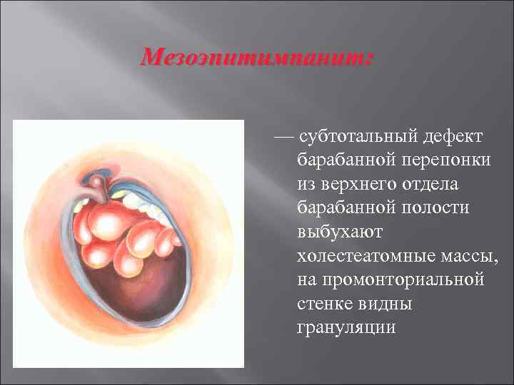 Мезоэпитимпанит: — субтотальный дефект барабанной перепонки из верхнего отдела барабанной полости выбухают холестеатомные массы,