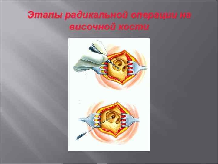 Этапы радикальной операции на височной кости 