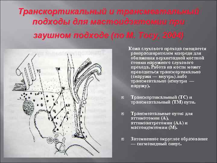 Транскортикальный и трансмеатальный подходы для мастоидэктомии при заушном подходе (по М. Тосу, 2004) Кожа