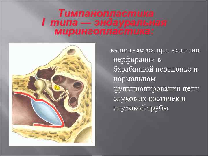 Тимпанопластика I типа — эндауральная мирингопластика: выполняется при наличии перфорации в барабанной перепонке и