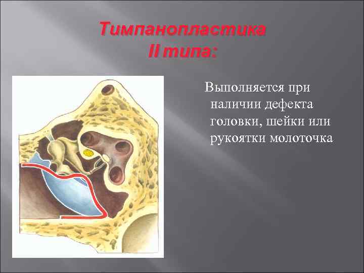 Тимпанопластика II типа: Выполняется при наличии дефекта головки, шейки или рукоятки молоточка 
